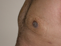 after male breast enlargement